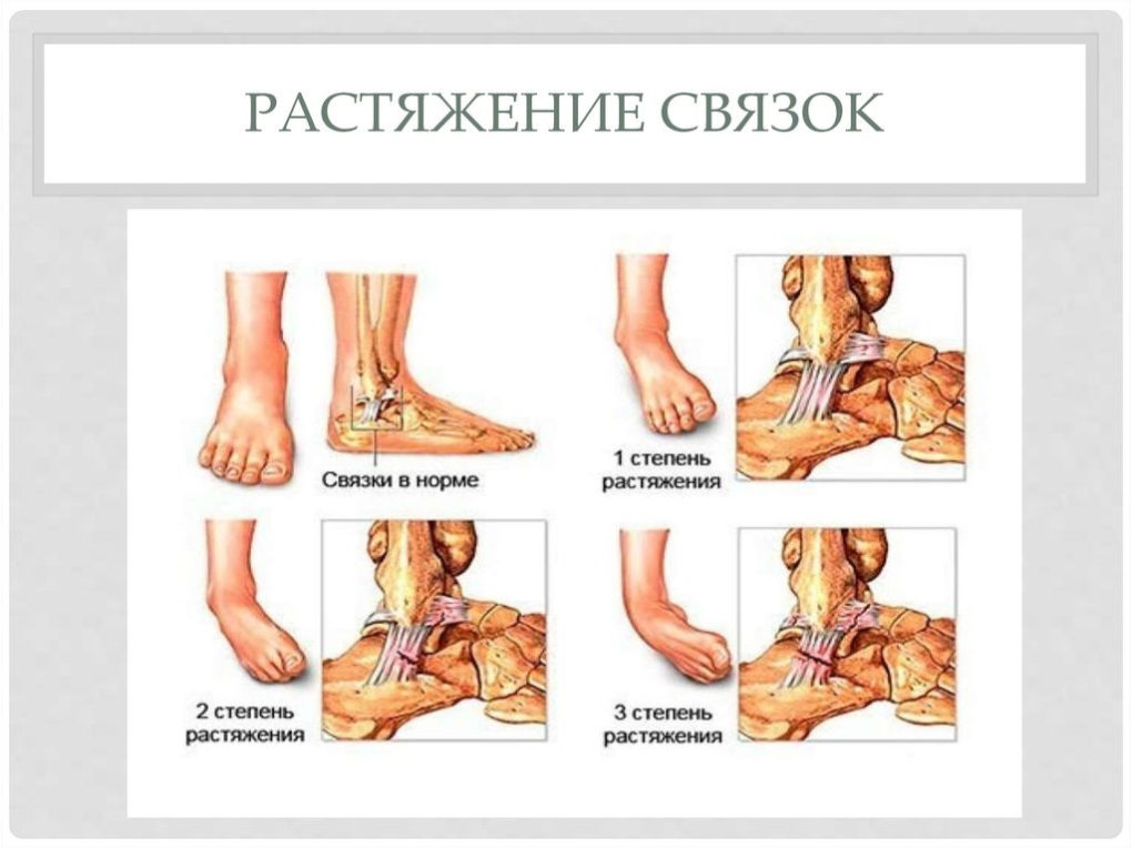 Растяжение связок. Признаки, первая помощь